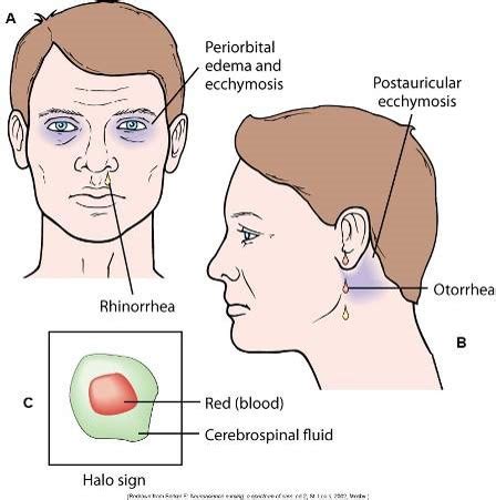 halo sign csf|Traumatic Cerebrospinal Fluid Leaks